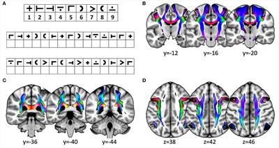 Performance in information processing speed is associated with parietal white matter tract integrity in multiple sclerosis